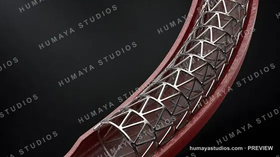 Coronary Stent in Artery 3D Illustration Medical Render